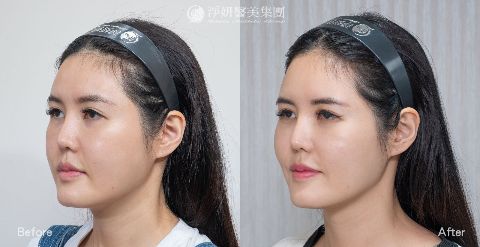  淨妍醫美案例分享_神力拉提_中臉