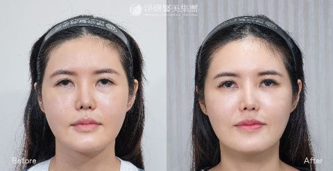  淨妍醫美案例分享_神力拉提_中臉