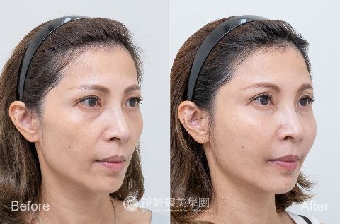 氧氣玻尿酸蘋果肌、頰凹以及法令紋