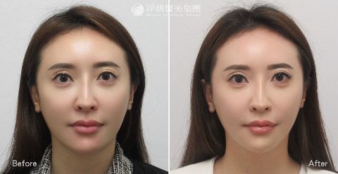 妮芙蕾_淚溝&蘋果肌&法令紋