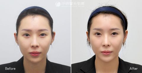 妮芙蕾_淚溝&蘋果肌&法令紋