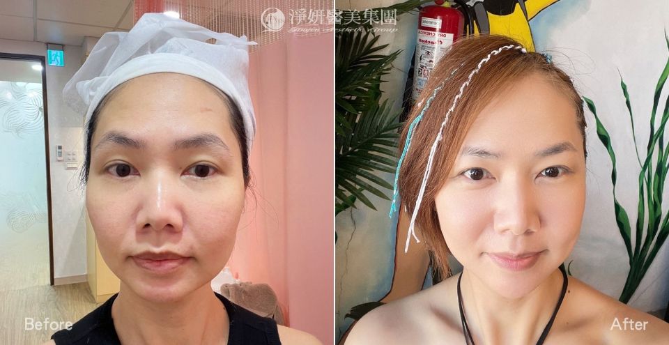 淨妍醫美妮芙蕾BA圖