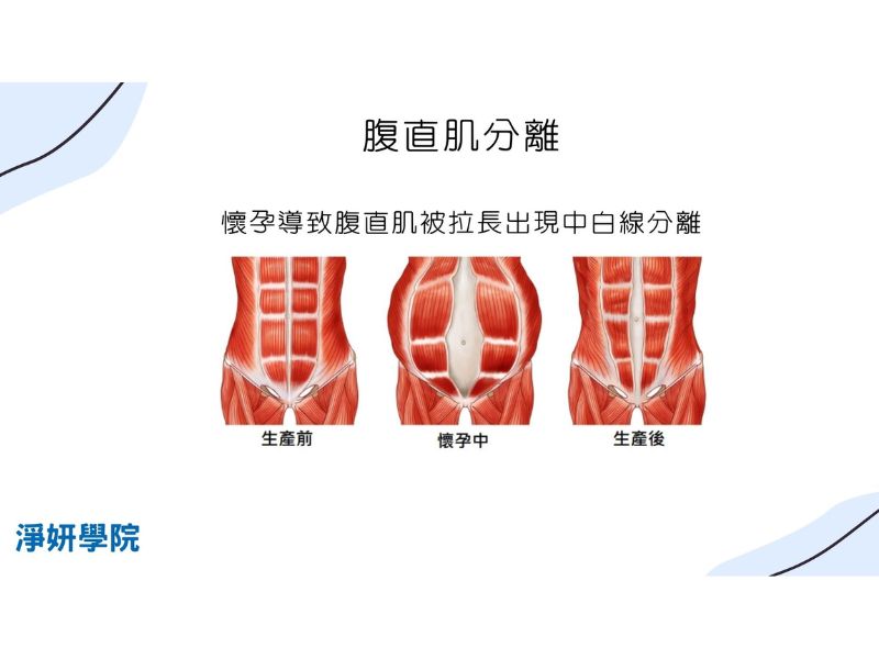 腹直肌分離常出現在剖腹產、寶寶過大的產後婦女身上