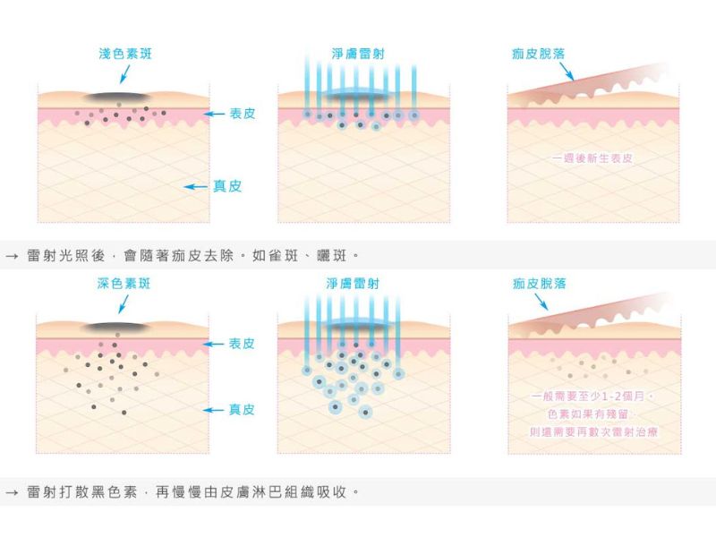 淨膚雷射原理