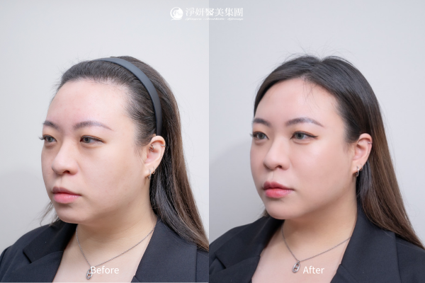 	Juvederm喬雅登玻尿酸共計12.3cc (外輪廓拉提、蘋果肌、淚溝、法令紋、下巴、臥蠶、唇)