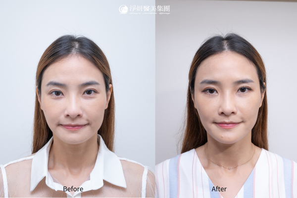 	Juvederm喬雅登玻尿酸共計12cc (夫妻宮、蘋果肌、臉頰、下顎線、下巴、法令紋、木偶紋)