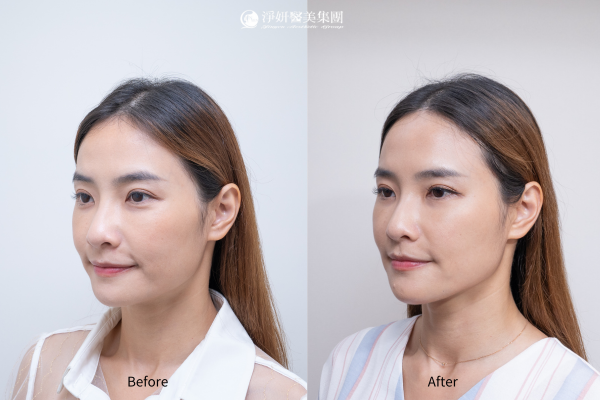 	Juvederm喬雅登玻尿酸共計12cc (夫妻宮、蘋果肌、臉頰、下顎線、下巴、法令紋、木偶紋)