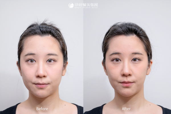 Juvederm喬雅登玻尿酸共計9cc(夫妻宮、下巴、臉頰、下顎線、法令紋)