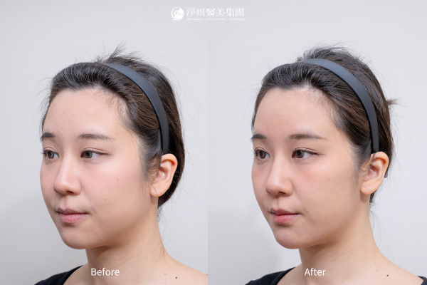 Juvederm喬雅登玻尿酸共計9cc(夫妻宮、下巴、臉頰、下顎線、法令紋)