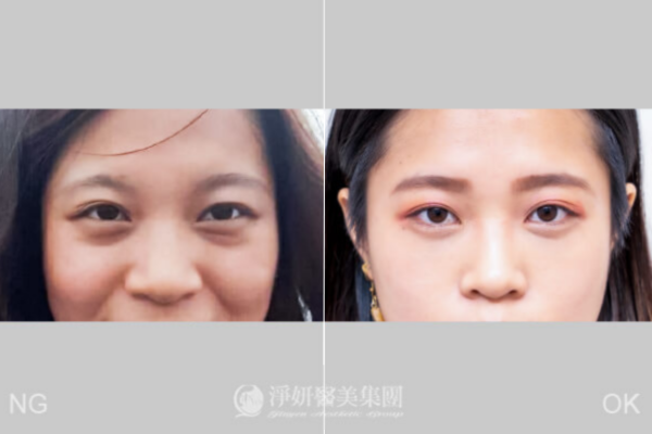 眼袋淚溝手術真實案例
