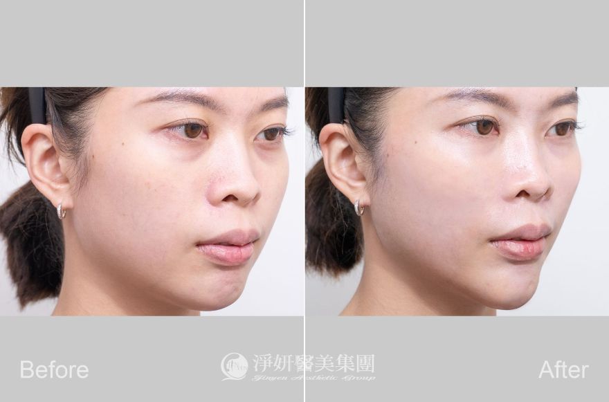 曾尹謙醫師也提醒大家，一定要選擇合格的醫療院所與專業的醫師，術前與醫師諮詢並明確表達在意的部位以及需要改善的需求，由專業醫師提供最適合的選擇之後再進行施打。