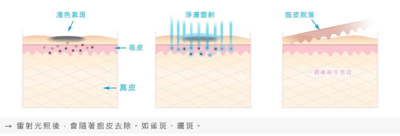 淨膚雷射治療淺層斑點效果佳