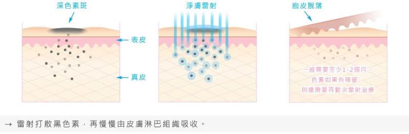 淨膚雷射治療深層斑點效果佳