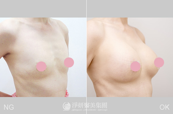 徐圭璋醫師的隆乳手術案例效果對比圖
