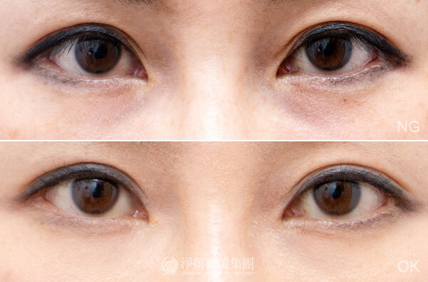 喬雅登玻尿酸Volite小分子劑型-眼下細紋(淨妍醫美診所(忠孝)案例)