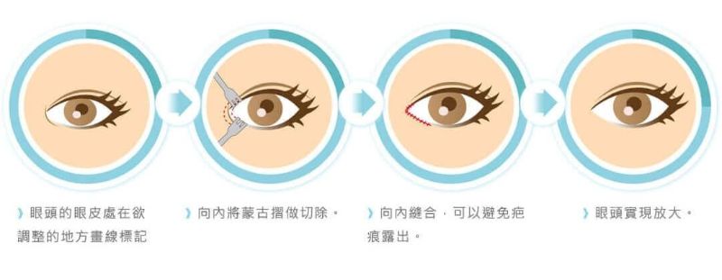 開眼頭眼尾手術說明