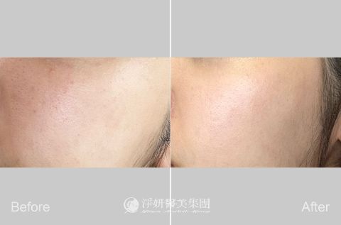 VIVABELLA薇貝拉50 (淨妍醫美(忠孝)案例)