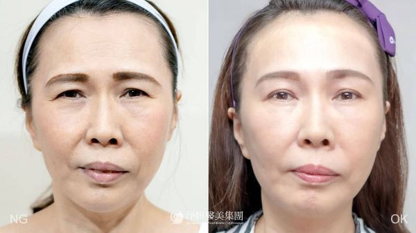 內視鏡拉皮手術改善額頭皺紋與肌膚下垂-陳承謙醫師-20210318