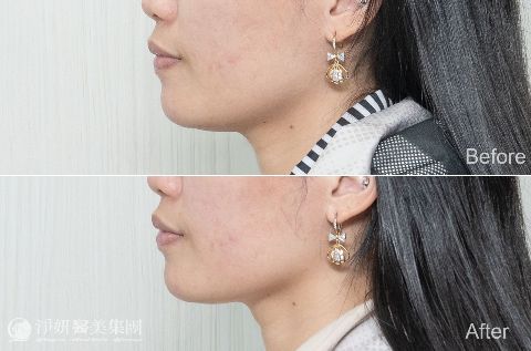 ONDA超微波_ 淨妍醫美案例