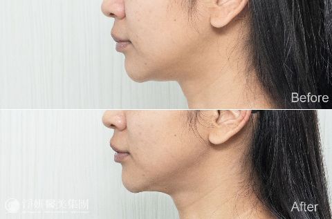 ONDA超微波_ 淨妍醫美案例