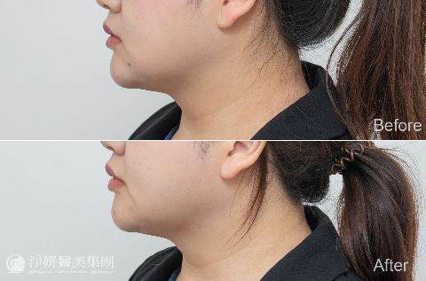 ONDA超微波_ 淨妍醫美案例