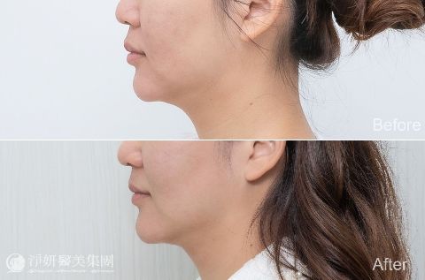 ONDA超微波_ 淨妍醫美案例
