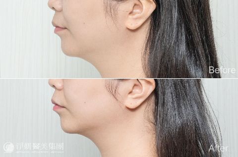 ONDA超微波_ 淨妍醫美案例
