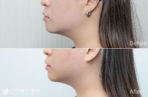 ONDA超微波_ 淨妍醫美案例