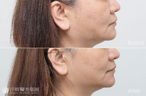 ONDA超微波_ 淨妍醫美案例