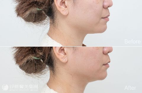 ONDA超微波_ 淨妍醫美案例