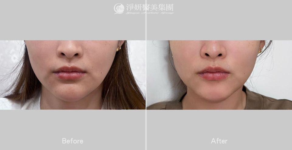 ONDA超微波_ 淨妍醫美案例