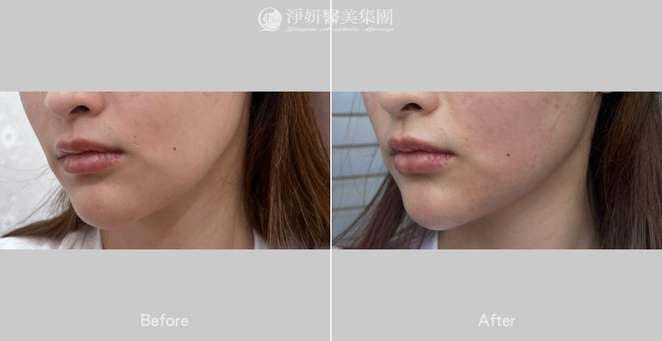 ONDA超微波_ 淨妍醫美栢添瀧醫師案例