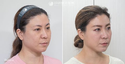 淨妍醫美PROFHILO逆時針真實案例分享