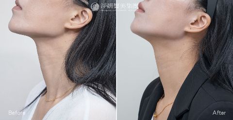 淨妍醫美PROFHILO逆時針真實案例分享