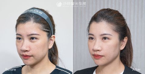 淨妍醫美PROFHILO逆時針真實案例分享