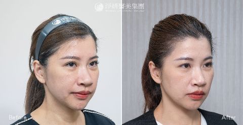 淨妍醫美PROFHILO逆時針真實案例分享
