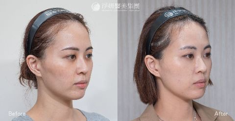 淨妍醫美PROFHILO逆時針真實案例分享