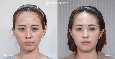 淨妍醫美PROFHILO逆時針真實案例分享
