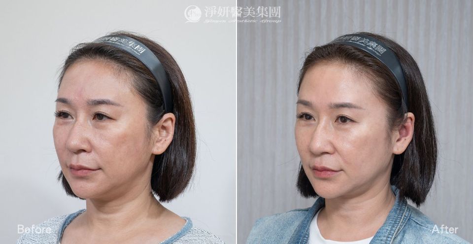 淨妍醫美PROFHILO逆時針真實案例分享