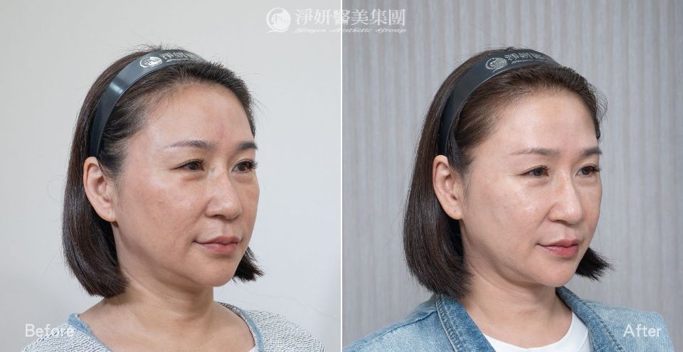 淨妍醫美PROFHILO逆時針真實案例分享