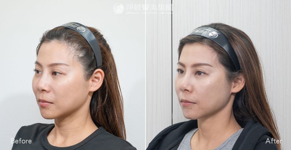 淨妍醫美PROFHILO逆時針真實案例分享