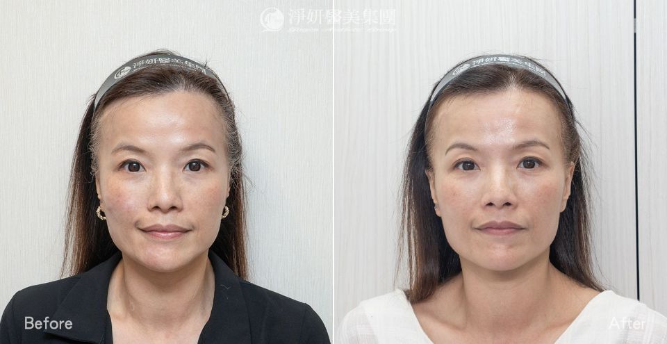 淨妍醫美PROFHILO逆時針真實案例分享
