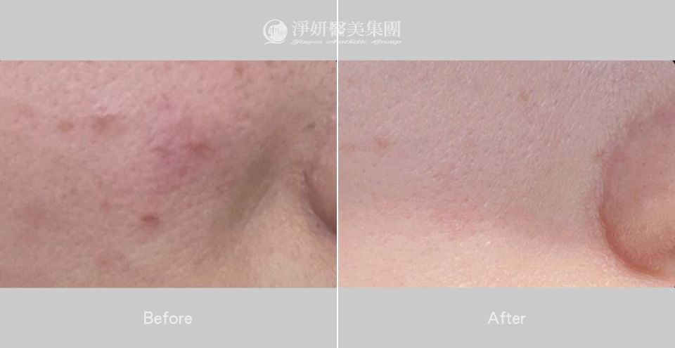 逆時針案例_淨妍醫美顏華志醫師