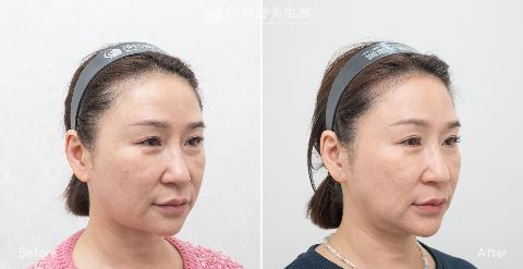 麗珠蘭Rejuran修復水光與白瓷水光