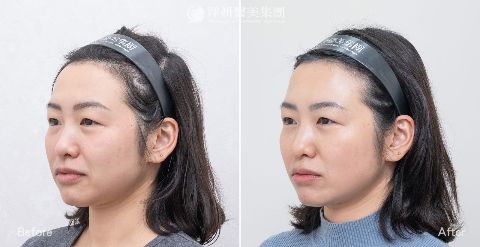 麗珠蘭Rejuran修復水光與白瓷水光