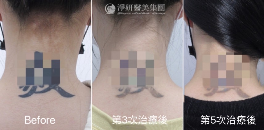 淨妍醫美除刺青公益 迷途青少年褪去過往