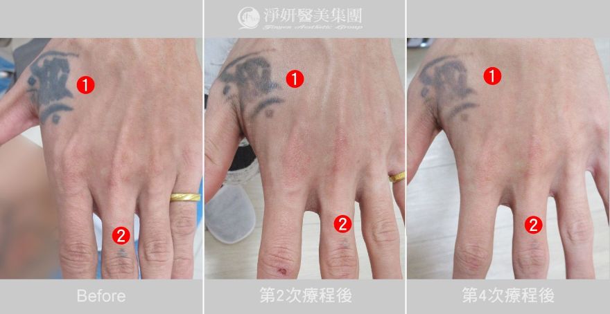 淨妍醫美公益除刺青 擴大資源回饋社會