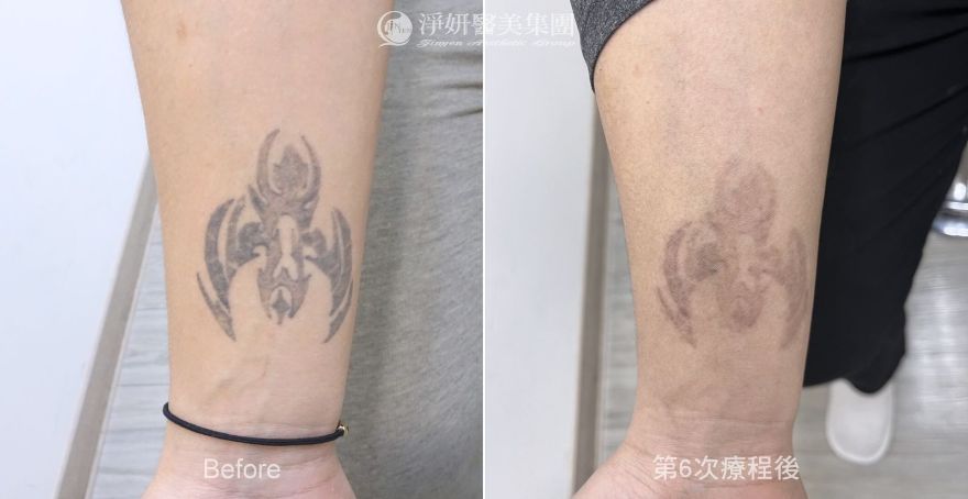 淨妍助消除印記 解開少心靈束縛