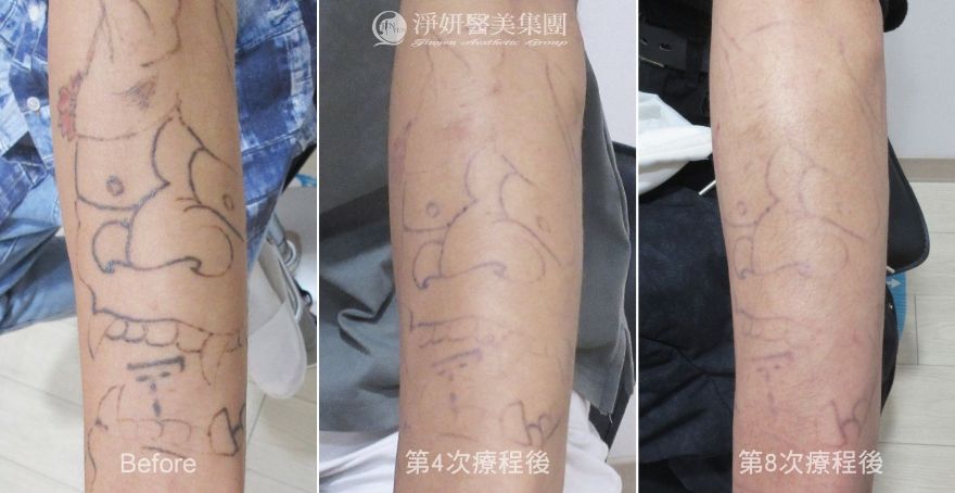 淨妍醫美皮秒雷射除刺青公益計畫