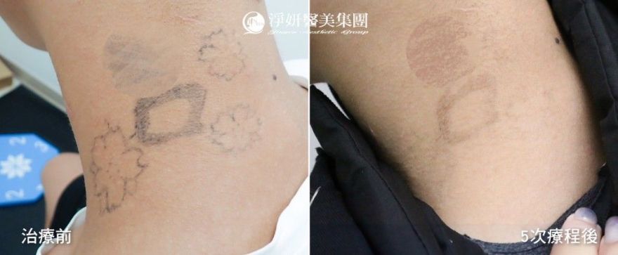 淨妍醫美集團「除刺青公益計畫」